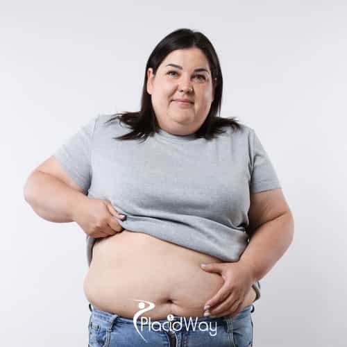 Gastric Sleeve in Turkey vs UK - Bypassing 36-Month NHS Wait Times for British Patients, Brands, and Quality Standards Compared